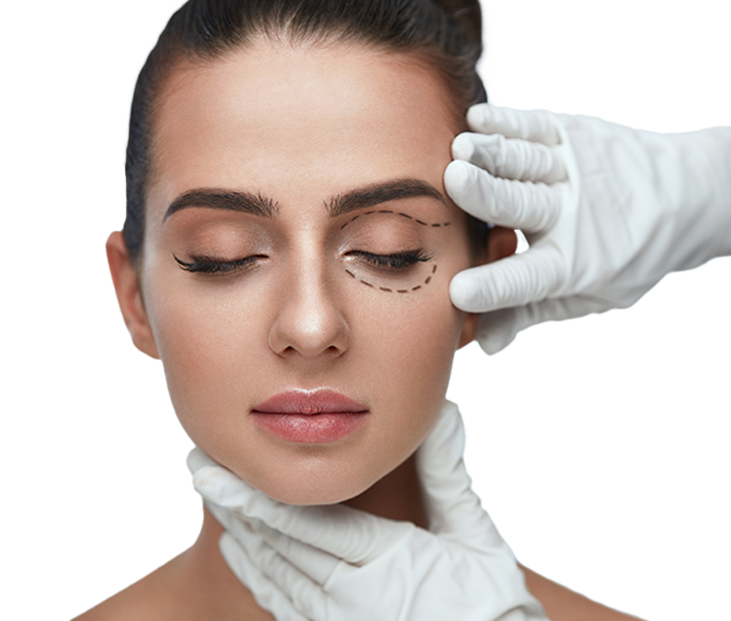 Blefaroplastia