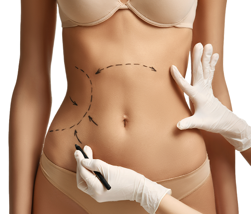 Lipoaspiração